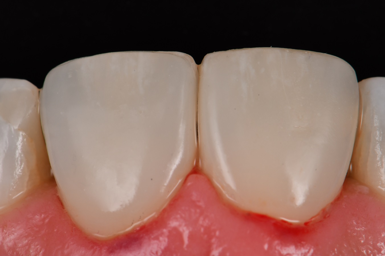 Voco Amaris Composite Veneers