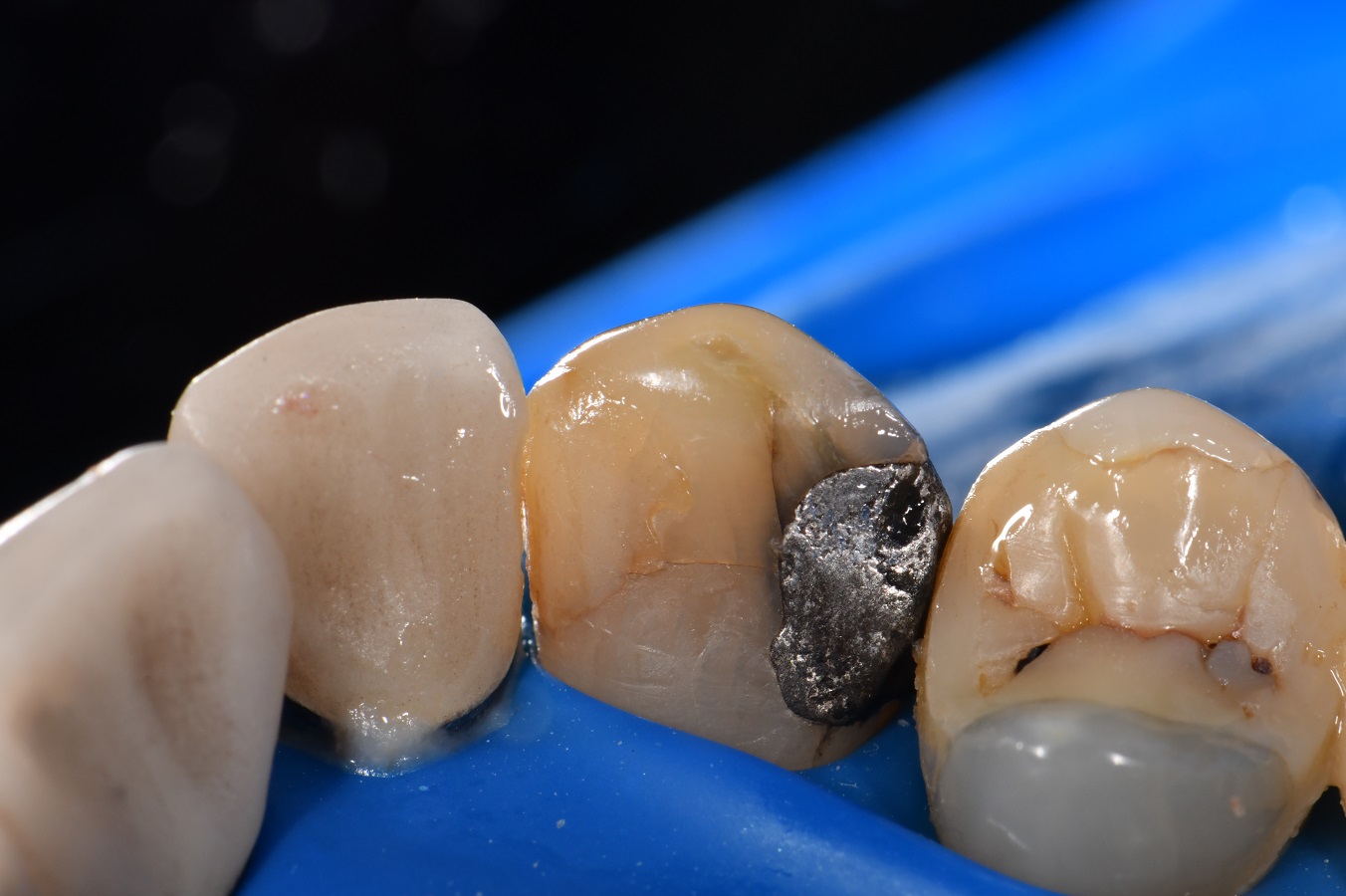 Amalgams induce crack formation in teeth