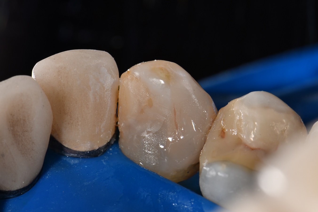 Amalgams induce crack formation in teeth