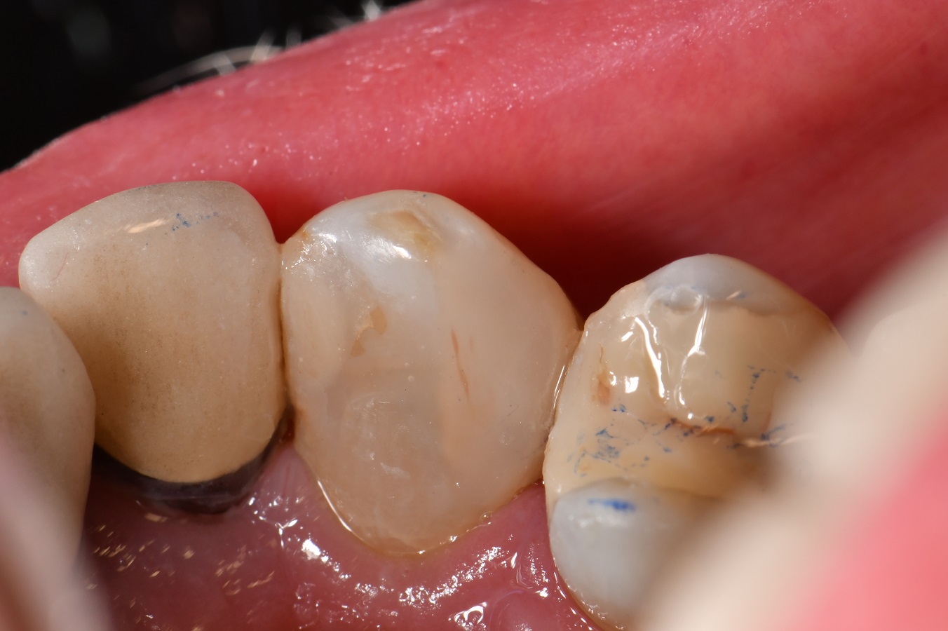 Amalgams induce crack formation in teeth
