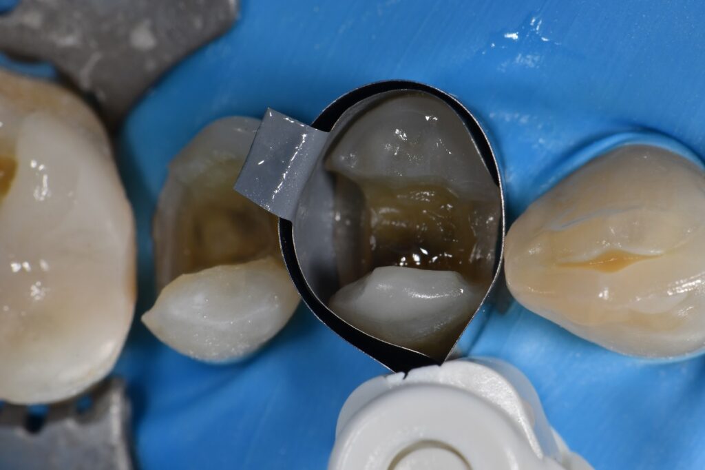 The Matrix in Matrix technique in dental restorations