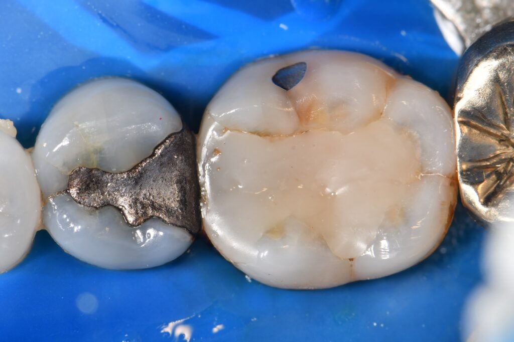 Stabilizing teeth with cracks caused by dental amalgams