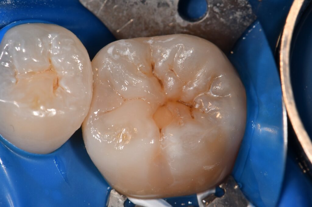 Amalgam removal and replacement with a