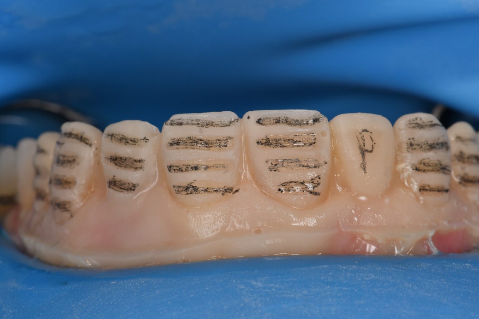 Orthodontics and Veneers with a Maryland Bridge design