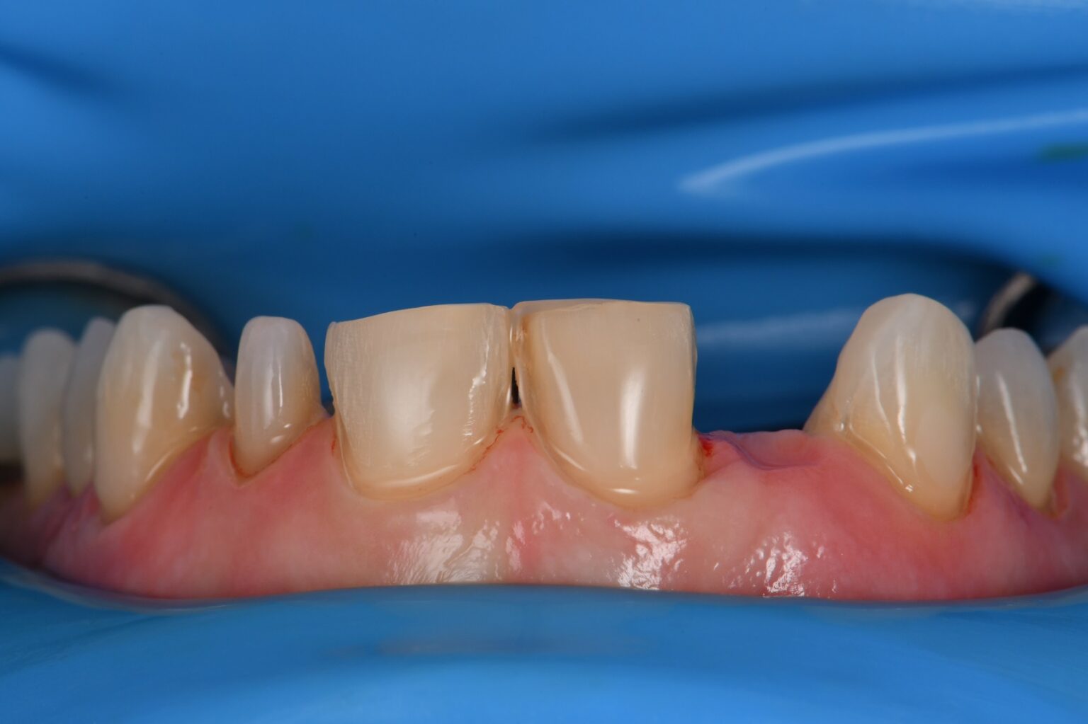 Orthodontics and Veneers with a Maryland Bridge design