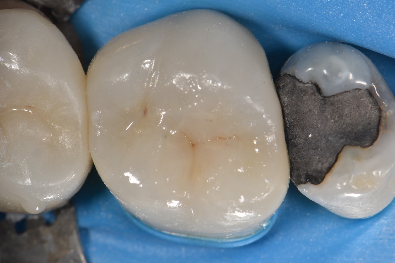 Endodontic Closure layering sequence