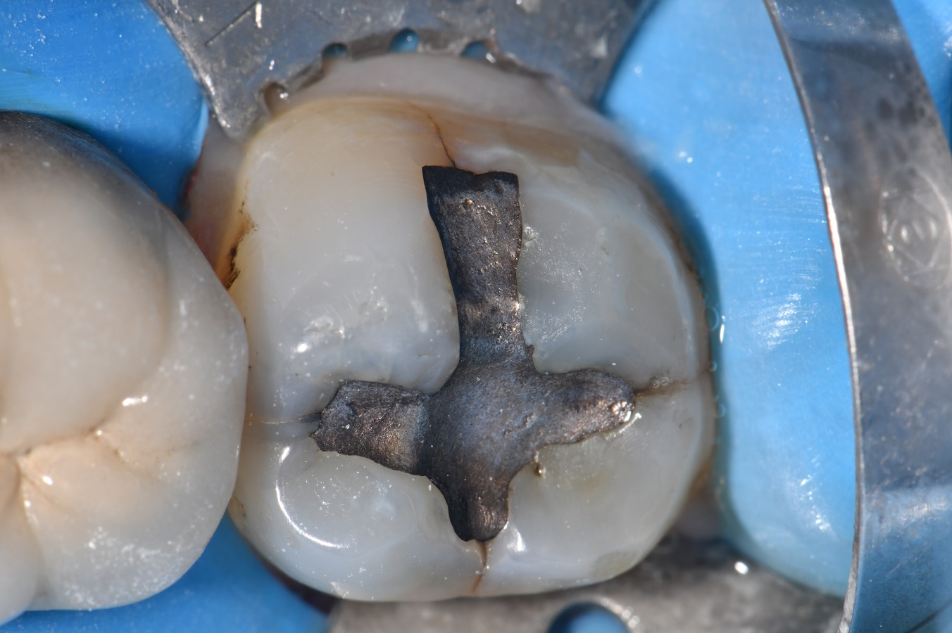 Compromised Tooth Supercomposite restoration of a crack compromised tooth