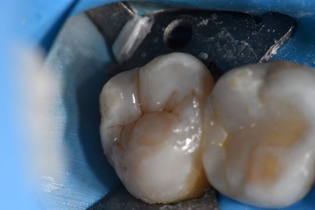How to use Bioceramic sealer in a dental pulpotomy