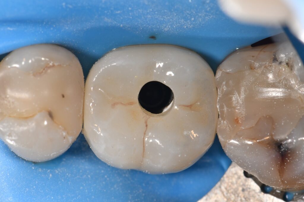 Atlantis Custom Zirconia Crown Ti Abutment Access Closure