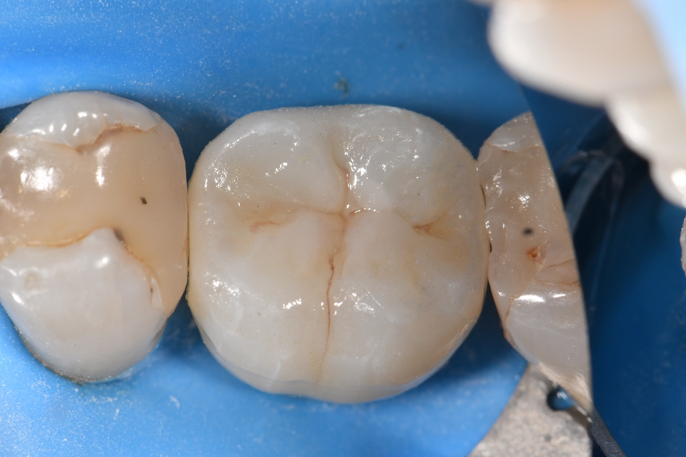 Atlantis Custom Zirconia Crown Ti Abutment Access Closure