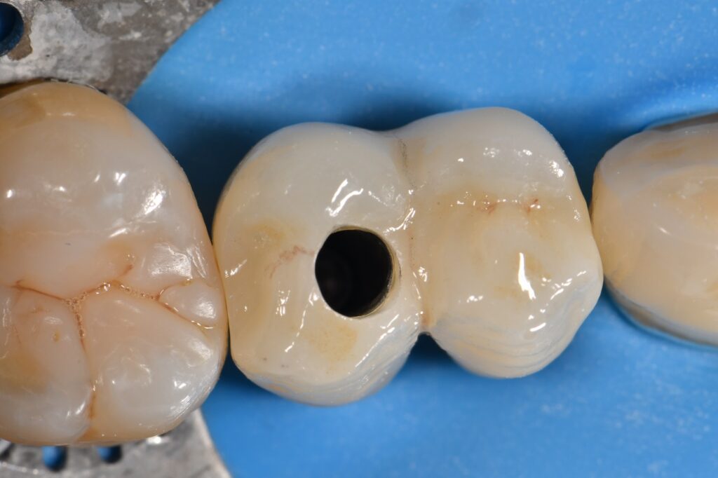 Atlantis custom abutment implant screw access closure