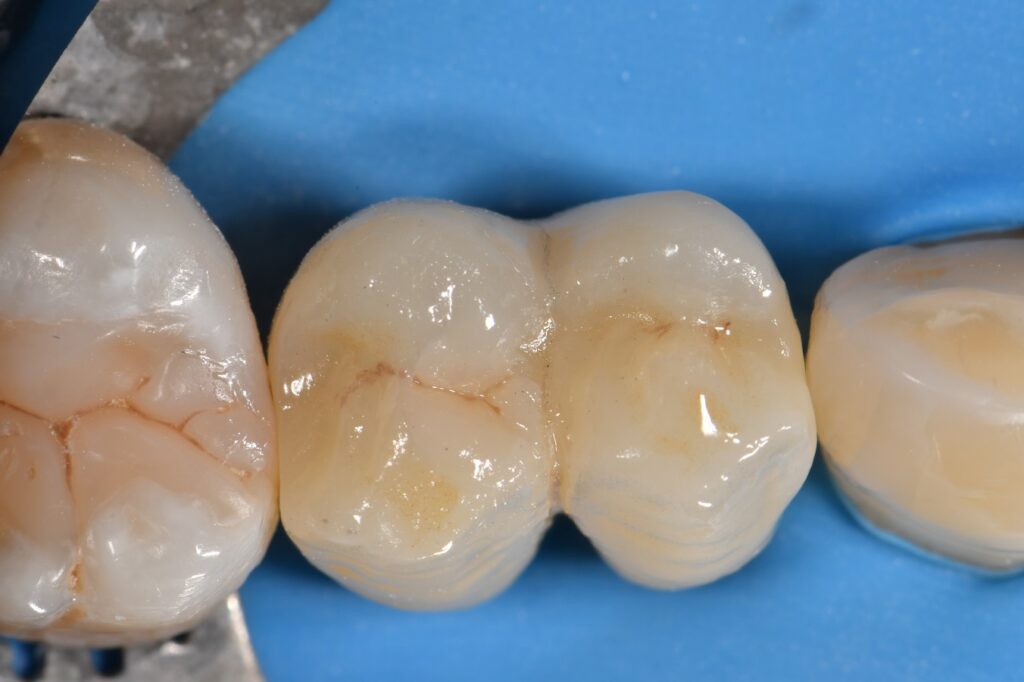 Atlantis custom abutment implant screw access closure