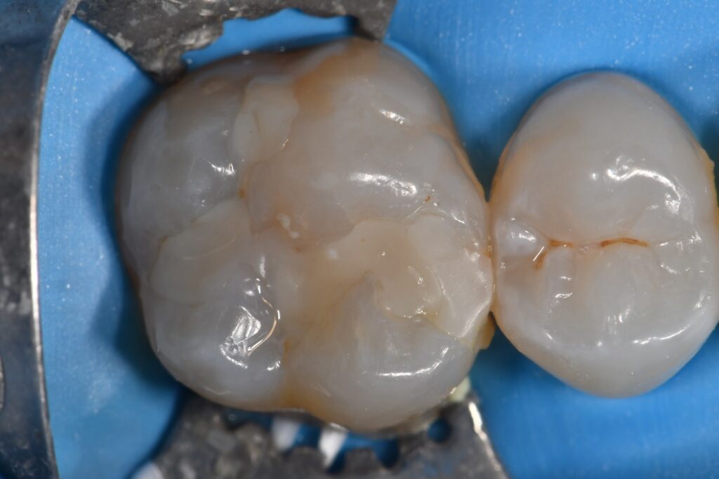 Sculpting natural fissures with composite resin