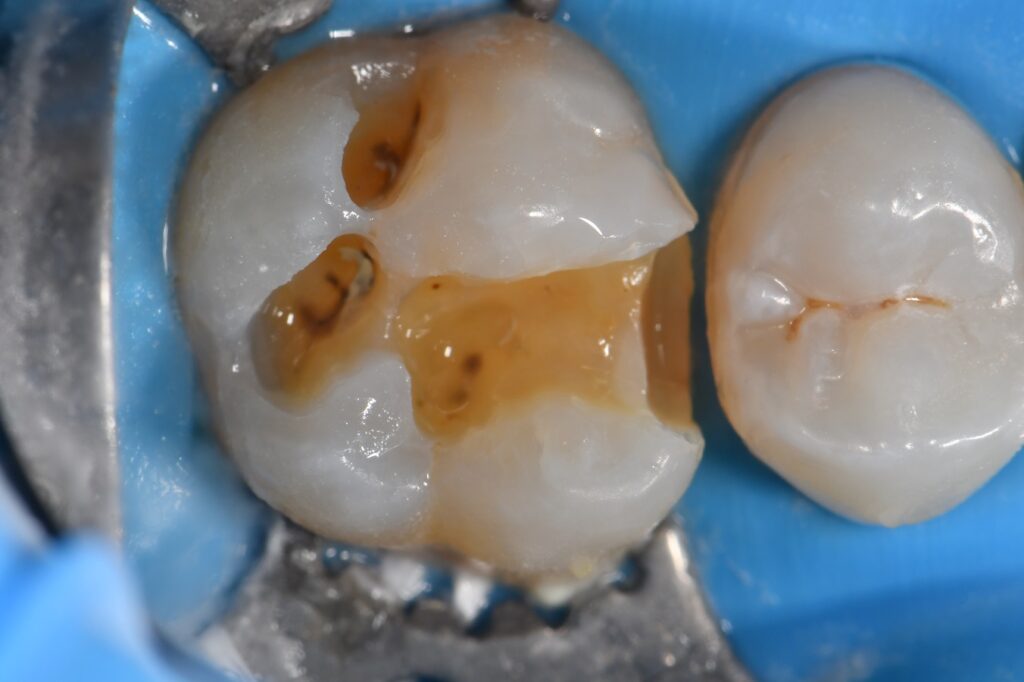 Sculpting natural fissures with composite resin