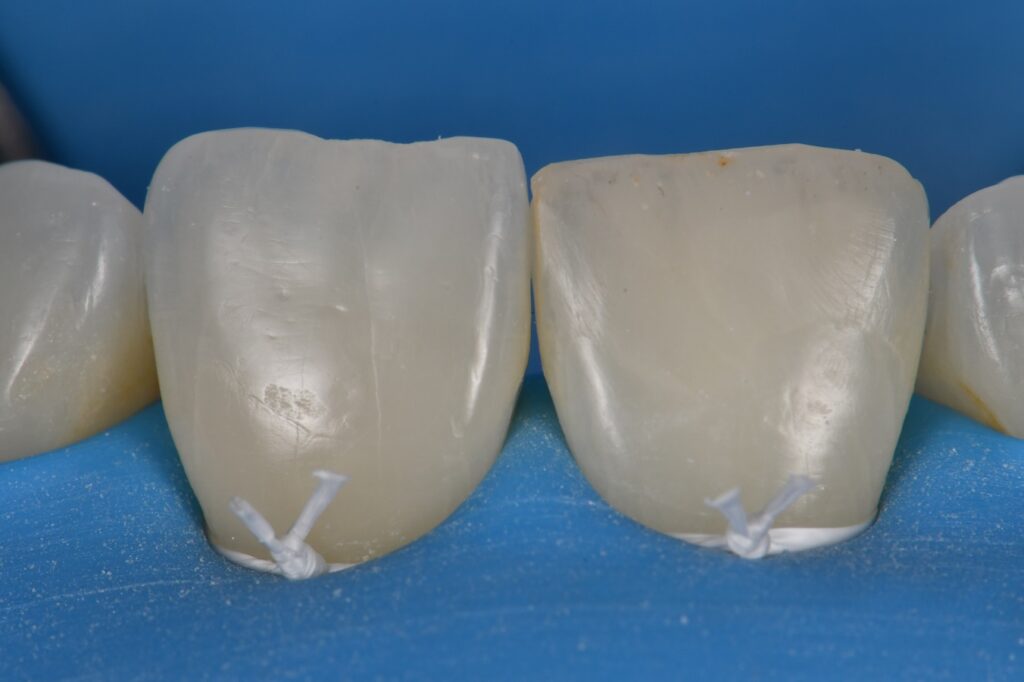 Layered Composite Partial Veneer with Voco Amaris