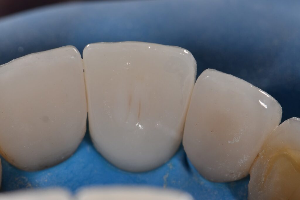 Bonding to Zirconia using Blatz APC technique