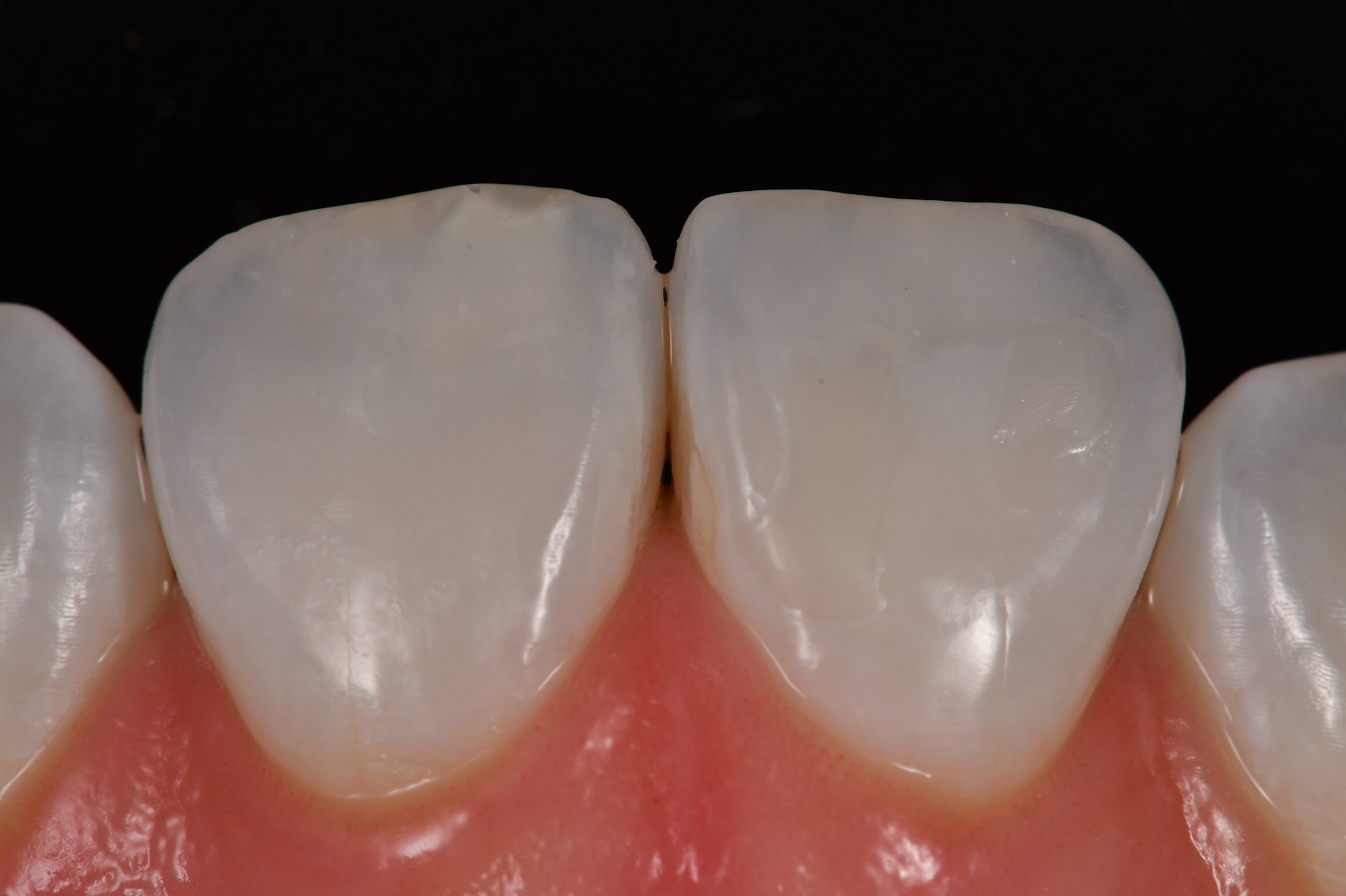 DMG Resin Infiltration no drill no fill