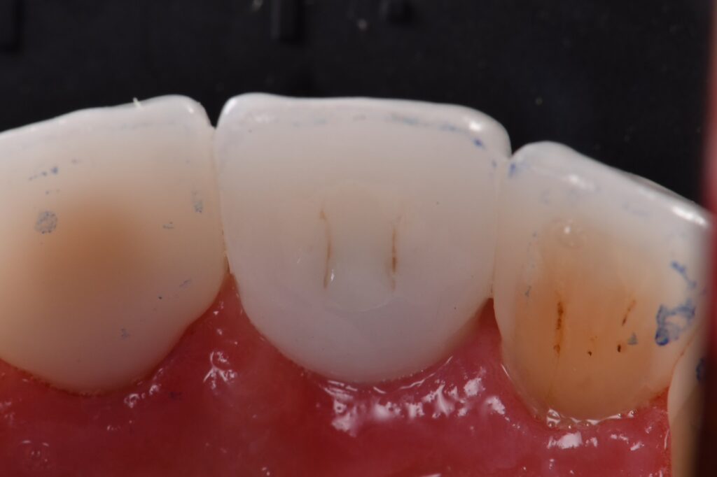 Bonding to Zirconia using Blatz APC technique