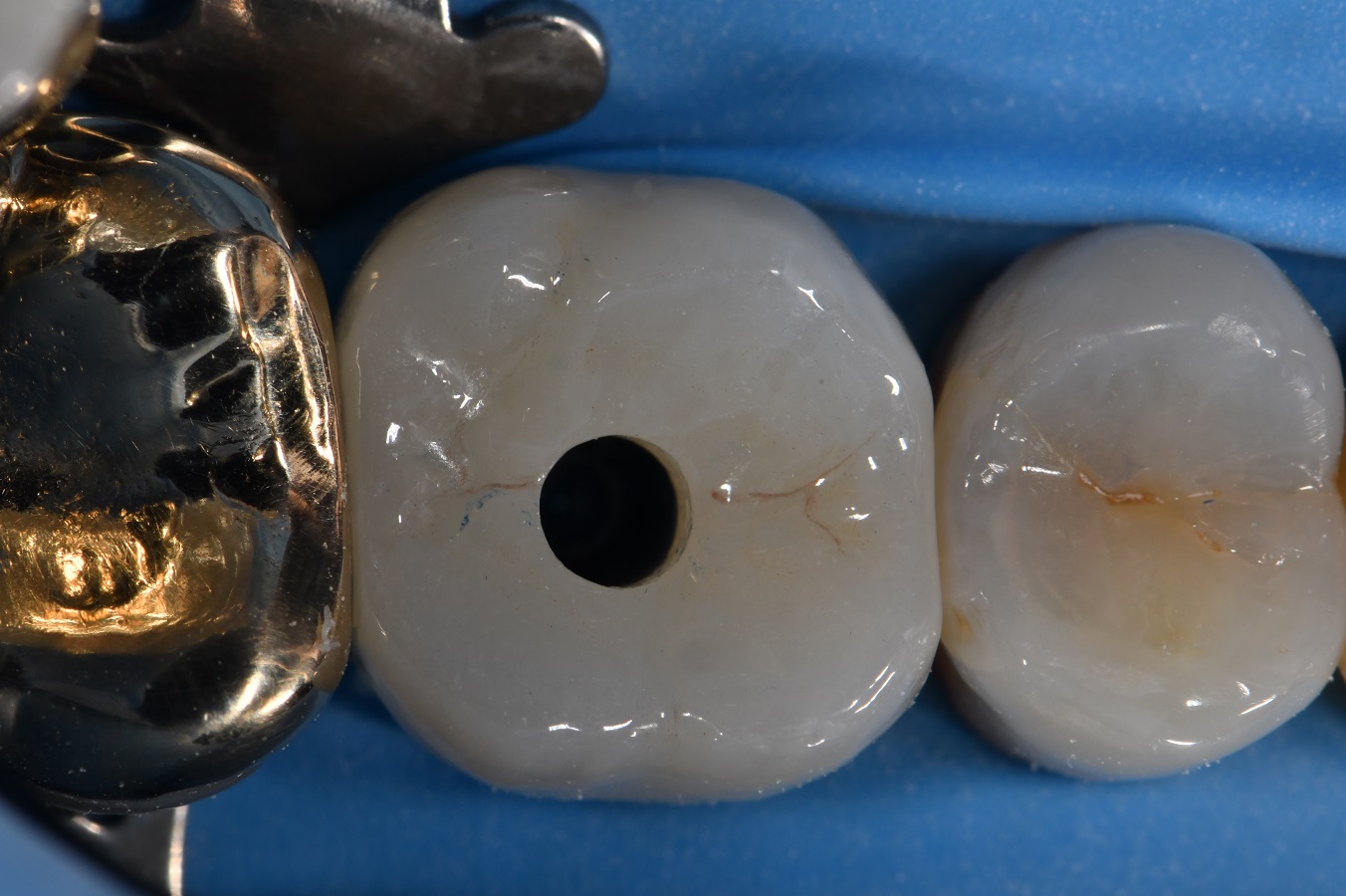 APC Technique in Zirconia Bonding for Implant Screw Access Closures