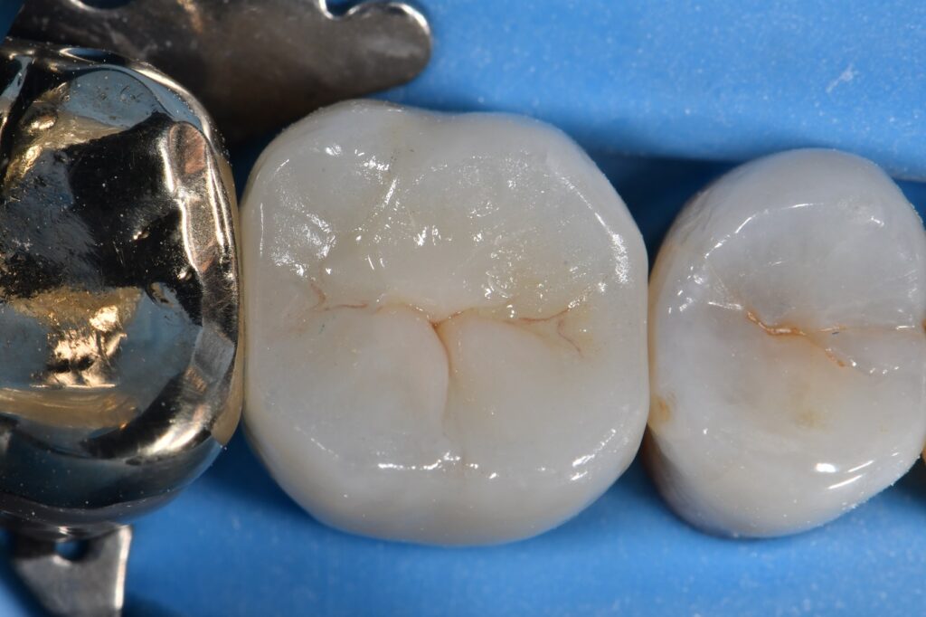 APC Technique in Zirconia Bonding for Implant Screw Access Closures