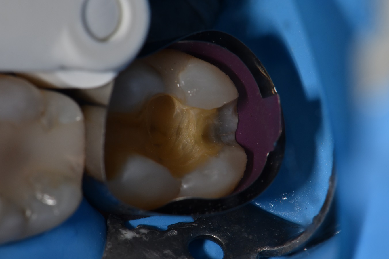 Short fiber reinforced composite restoration