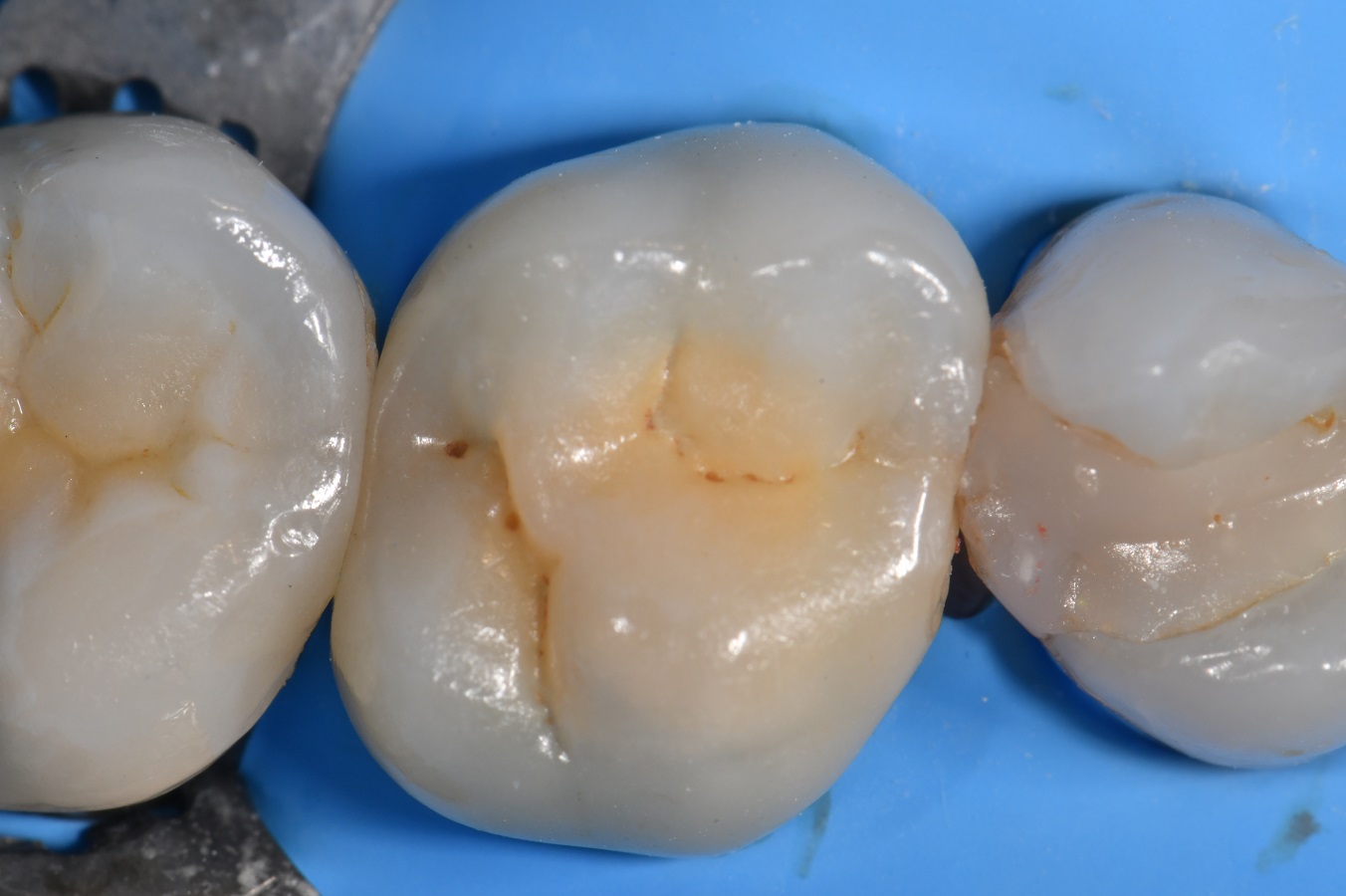 Brasseler Crown Spreader use Crown Workflow