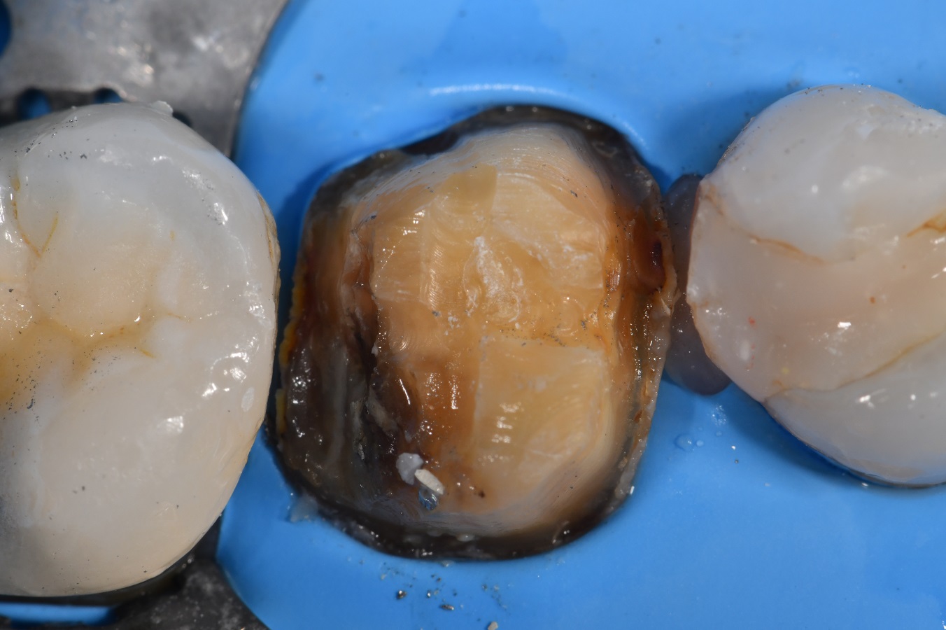 Brasseler Crown Spreader use Crown Workflow