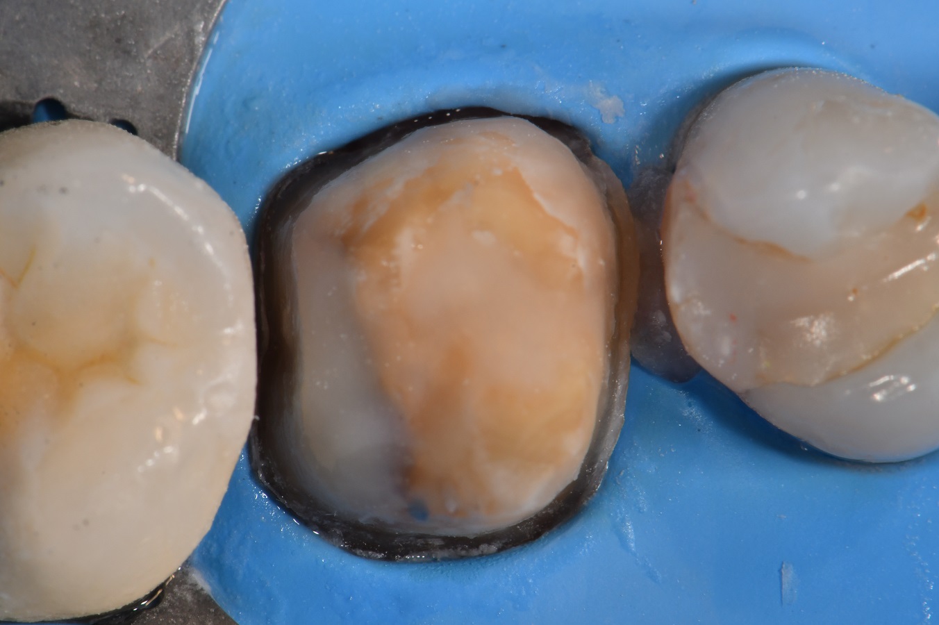 Brasseler Crown Spreader use Crown Workflow