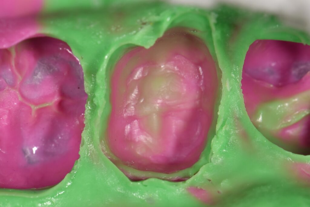 Brasseler Crown Spreader use Crown Workflow