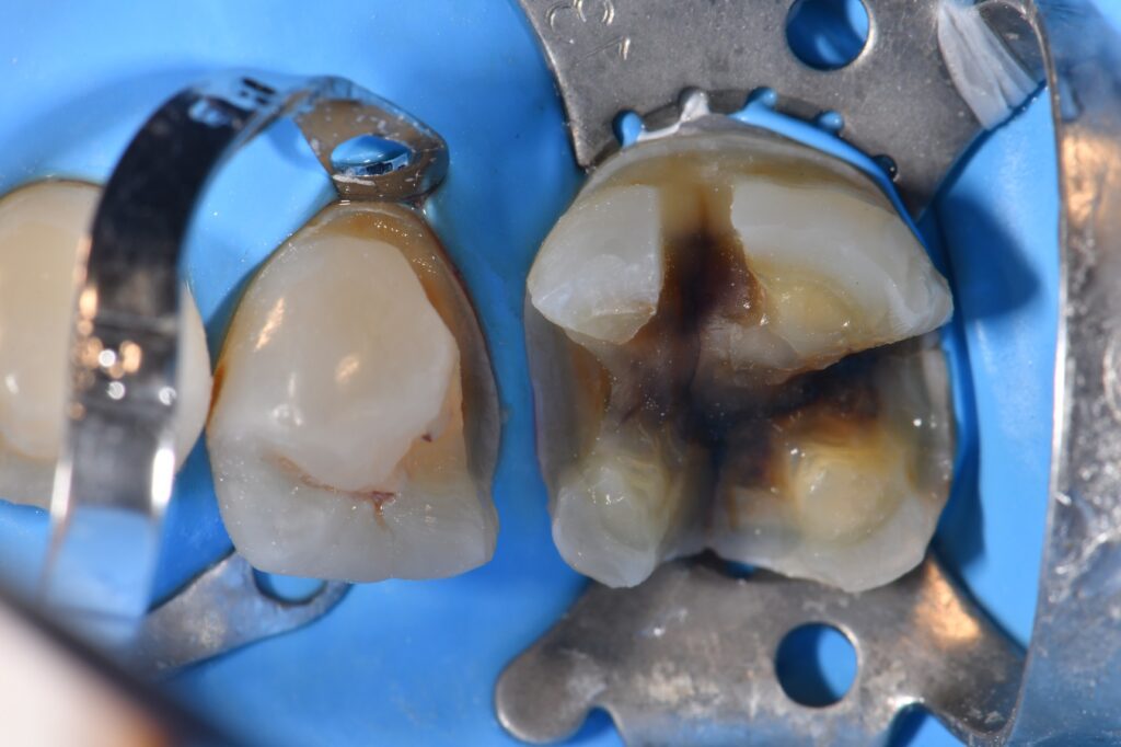 Chasing Cracks in Amalgamfilled teeth