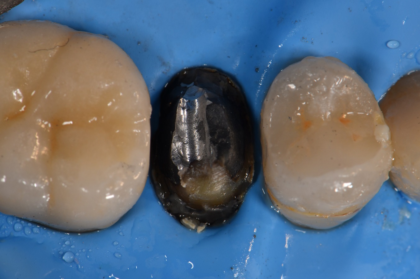 Lithium disilicate is lit