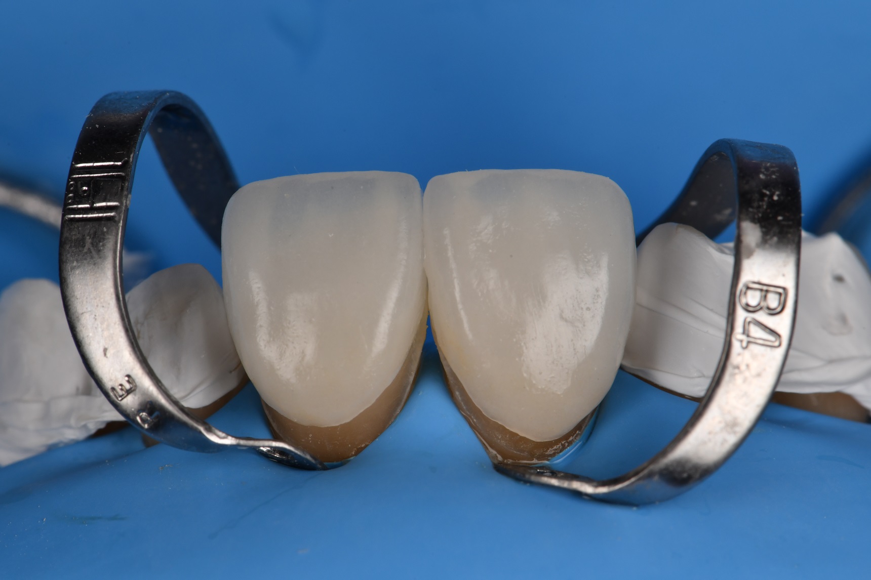 Absolute Isolation for Adhesive Cementation of Veneers
