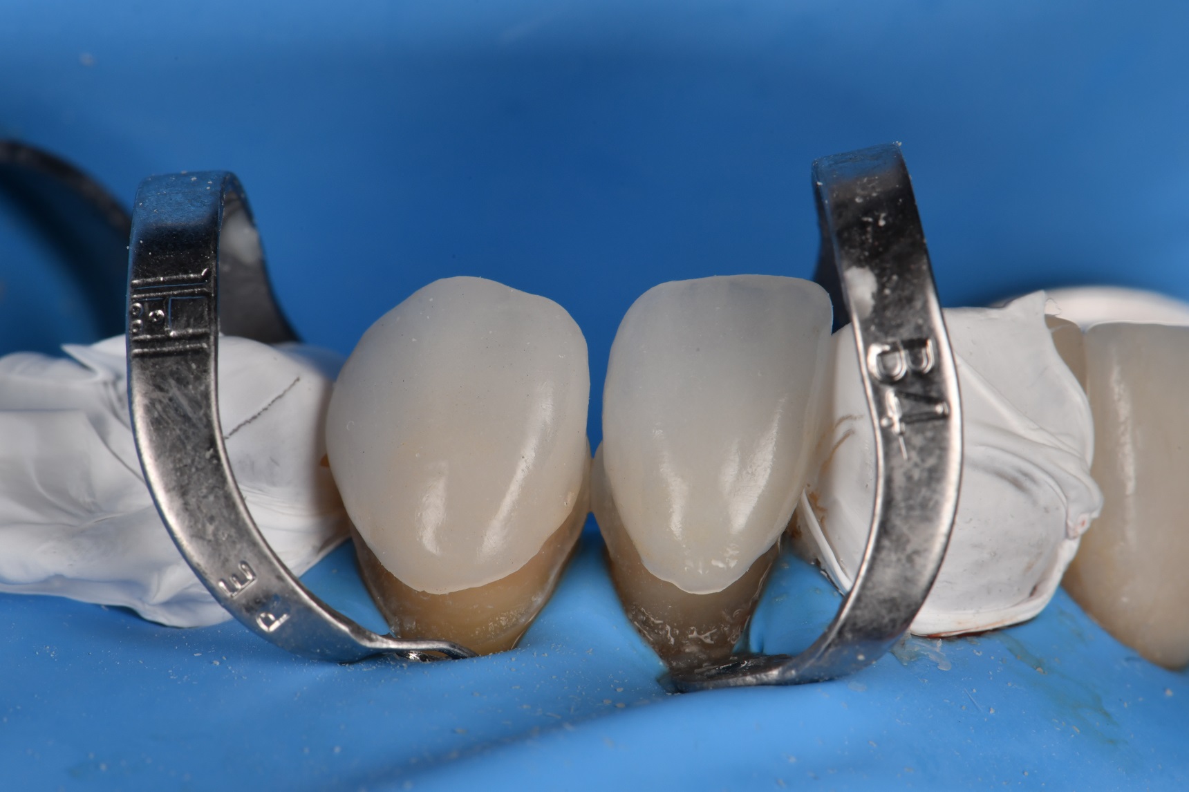 Absolute Isolation for Adhesive Cementation of Veneers