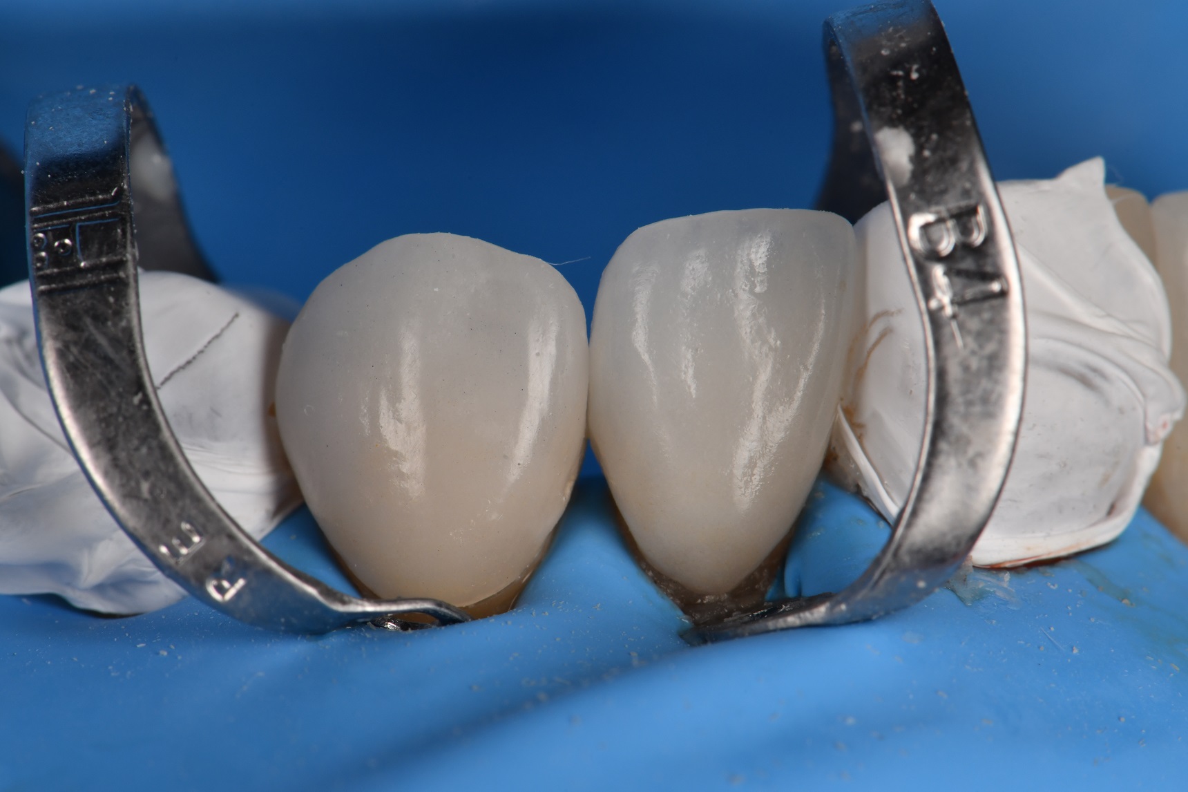 Absolute Isolation for Adhesive Cementation of Veneers