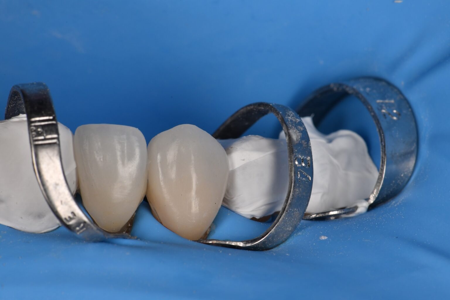 Absolute Isolation for Adhesive Cementation of Veneers