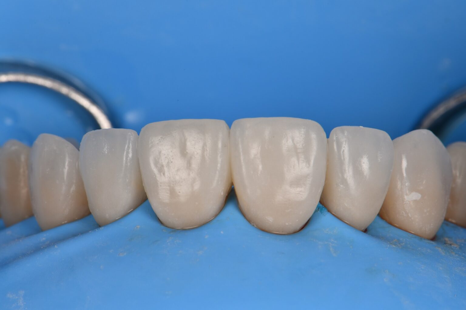 Absolute Isolation for Adhesive Cementation of Veneers