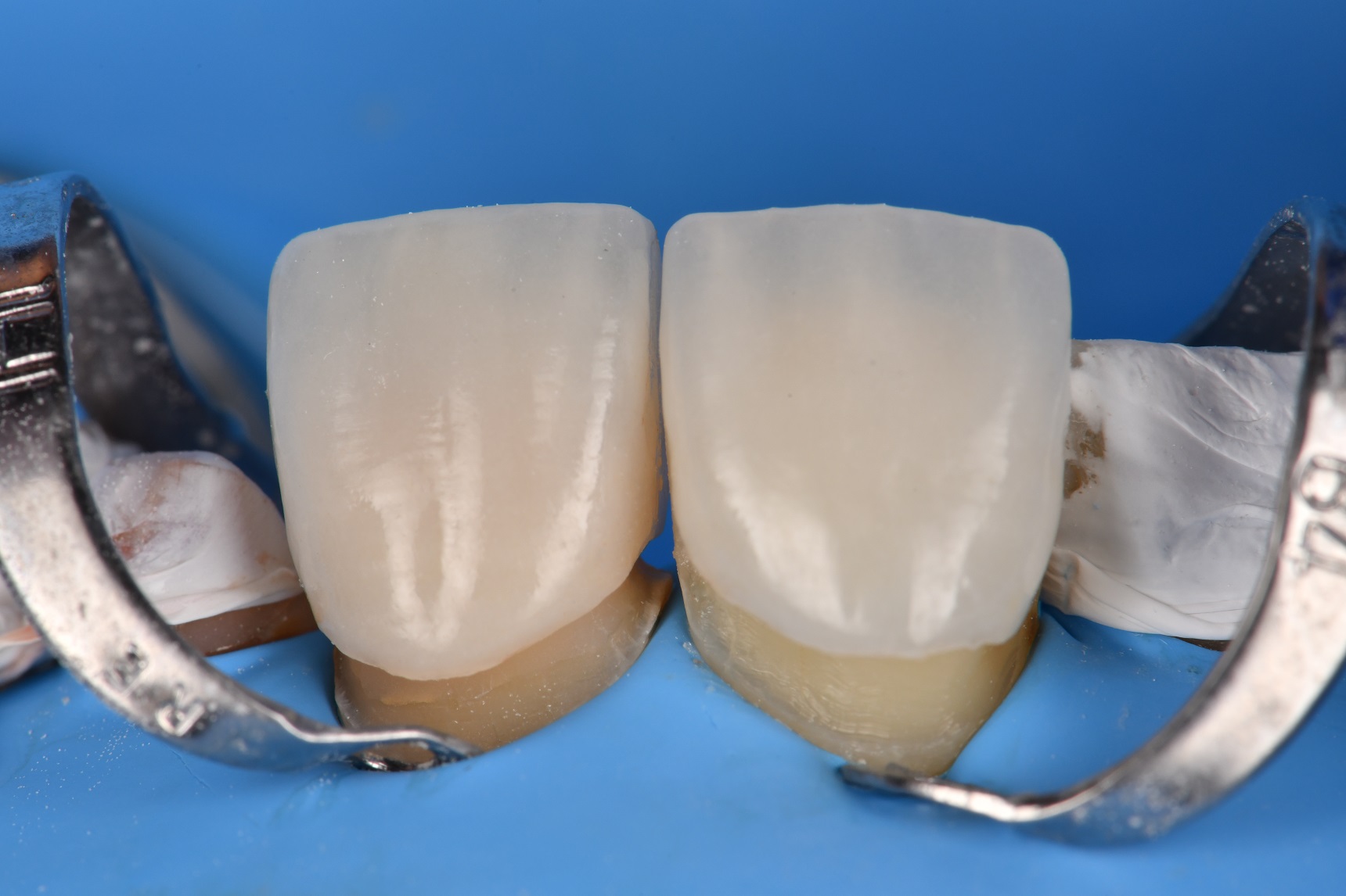 Adhesive Cementation of Veneers under Absolute Isolation