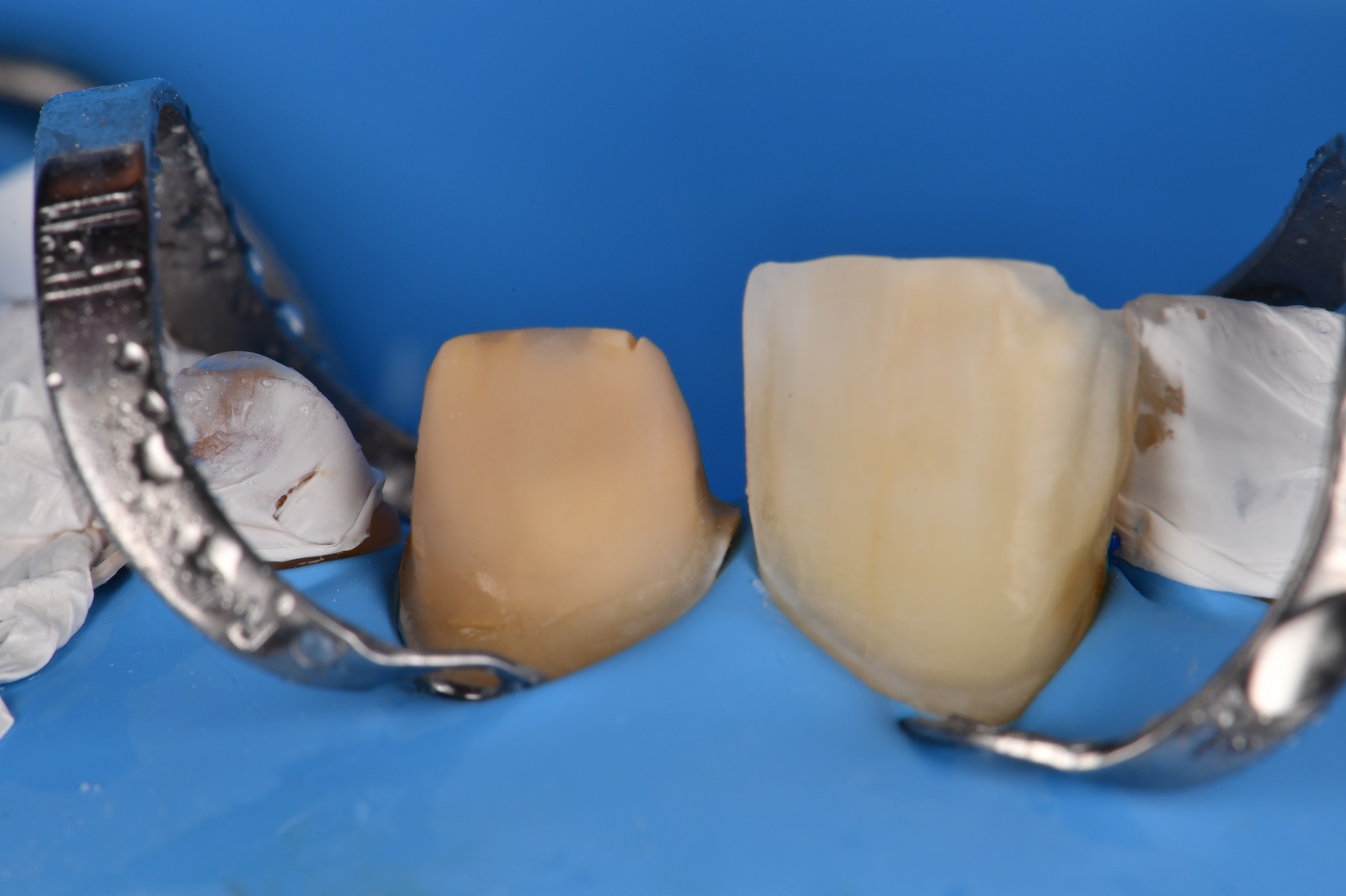Adhesive Cementation of Veneers under Absolute Isolation