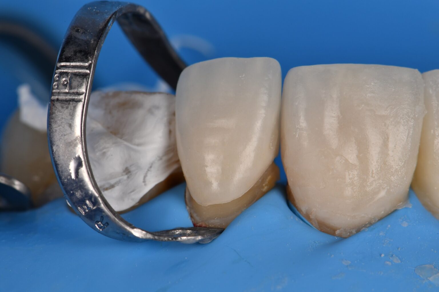 Adhesive Cementation of Veneers under Absolute Isolation