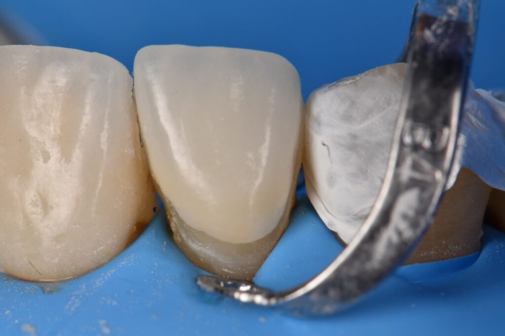Adhesive Cementation of Veneers under Absolute Isolation