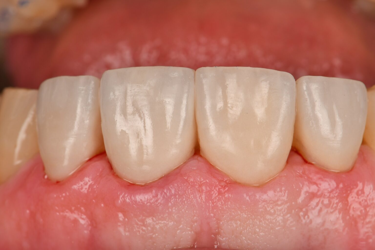 Adhesive Cementation of Veneers under Absolute Isolation