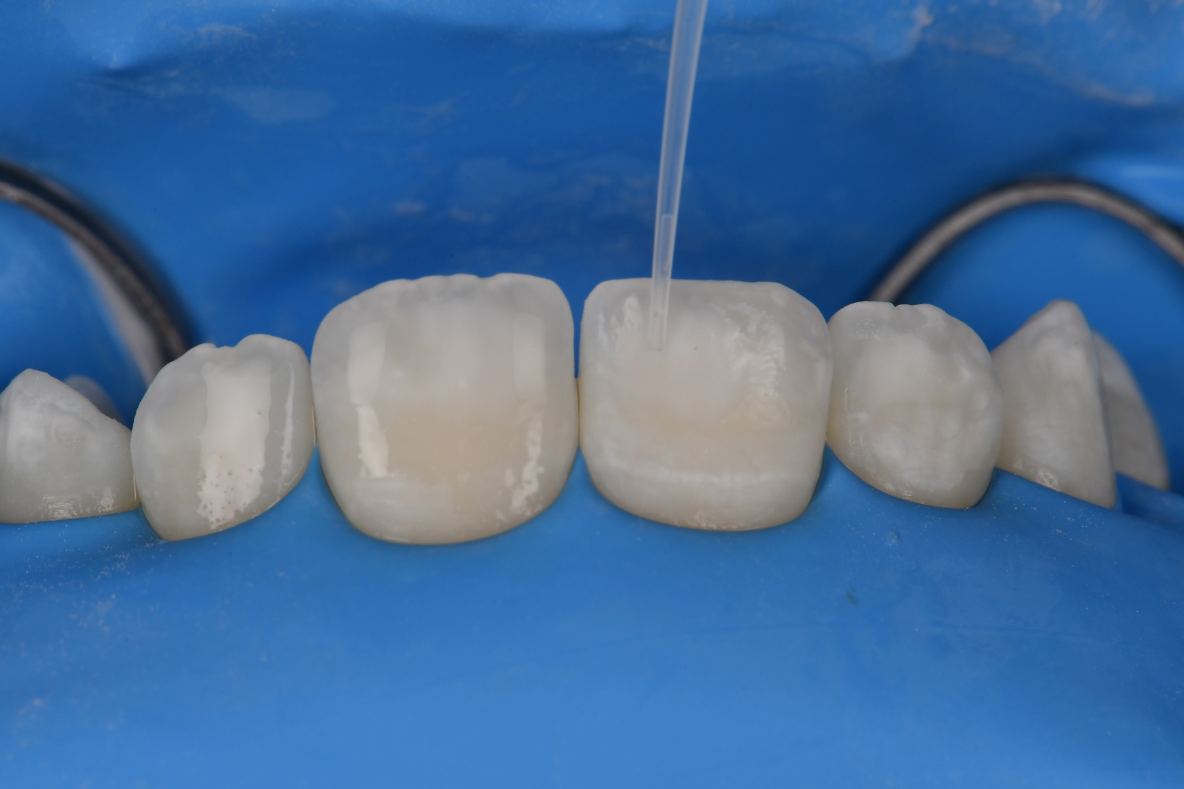 Non Invasive Resin Infiltration on a 13 year old female