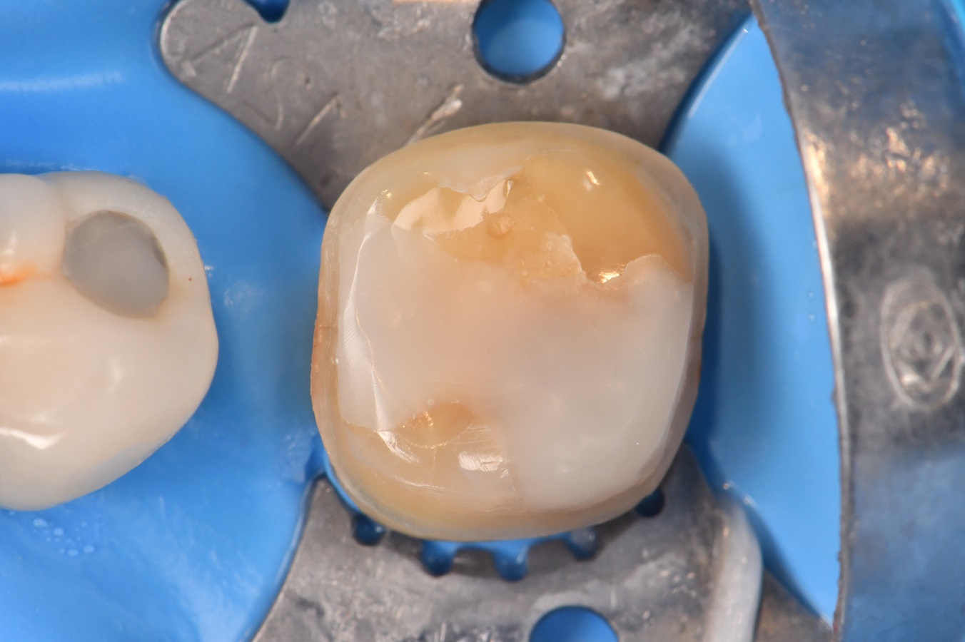 Minimum occlusal clearance values for Lithium Disilicate Ceramics