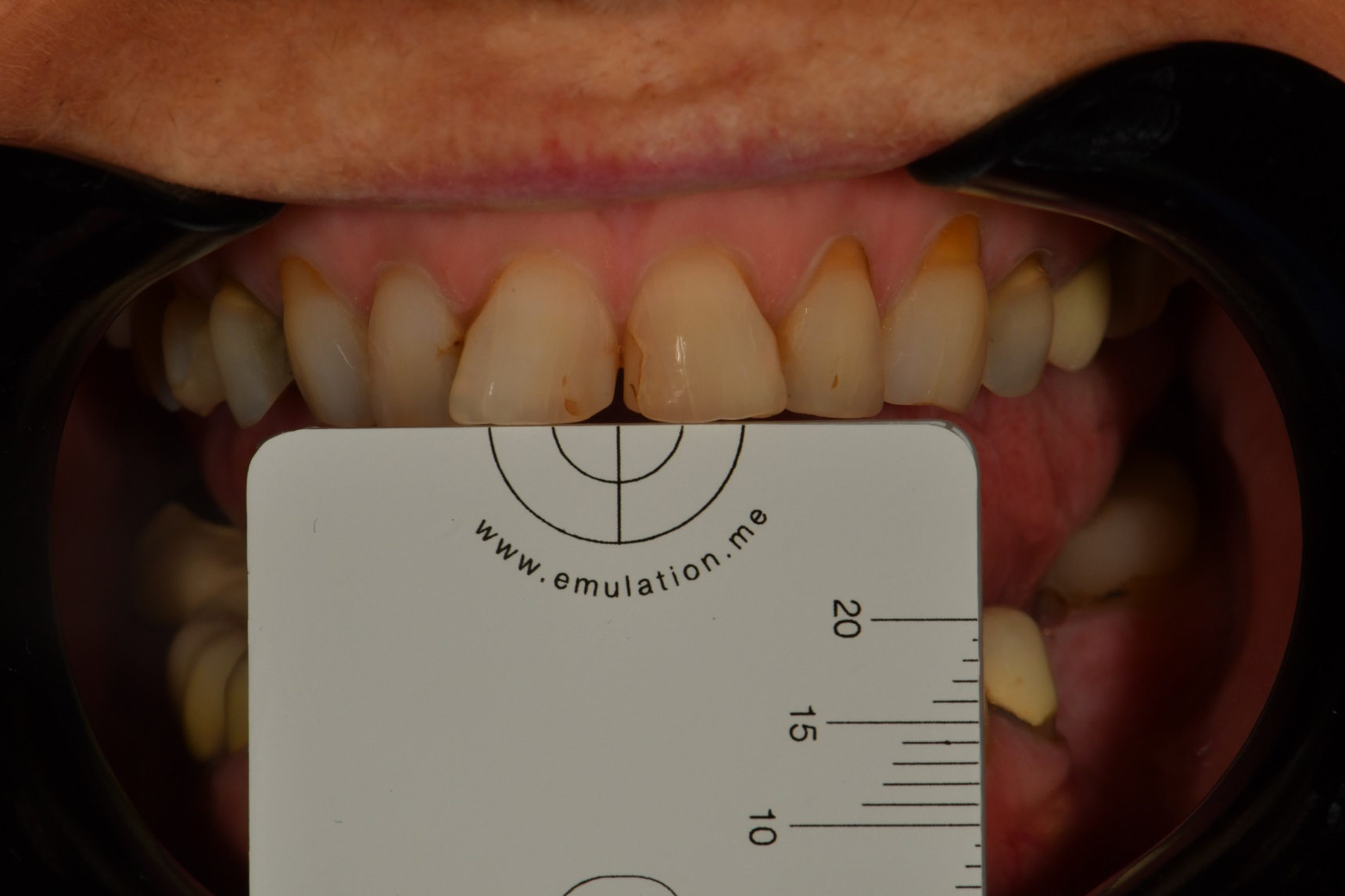 Preparations and Provisionals for an 8 unit porcelain dental makeover