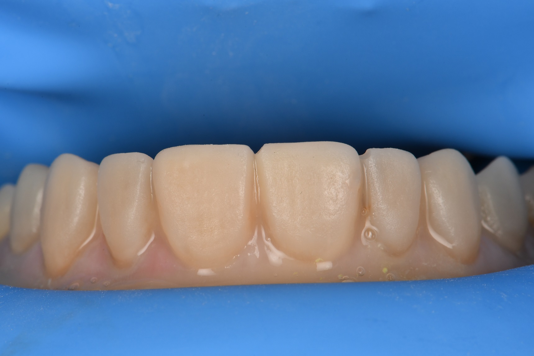 Preparations and Provisionals for an 8 unit porcelain dental makeover