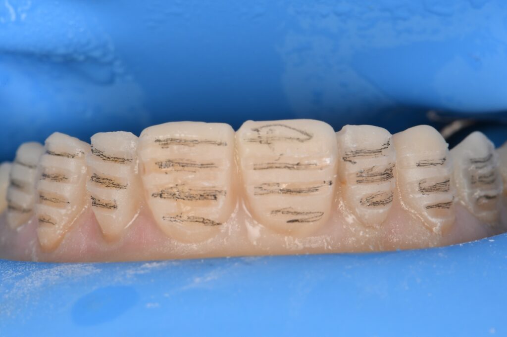 Preparations and Provisionals for an 8 unit porcelain dental makeover