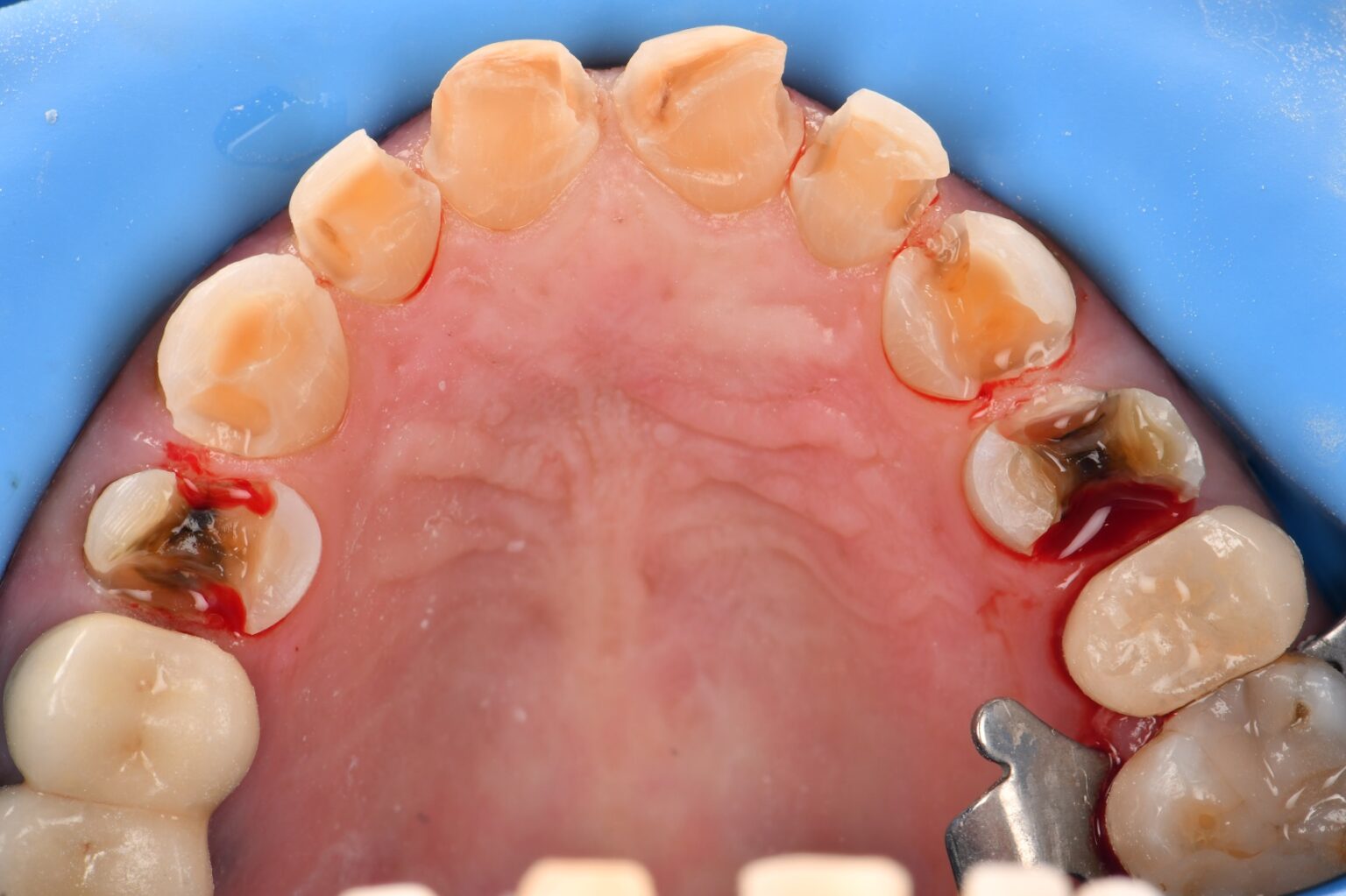 Preparations and Provisionals for an 8 unit porcelain dental makeover