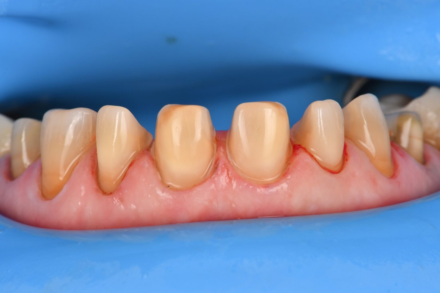 Preparations and Provisionals for an 8 unit porcelain dental makeover