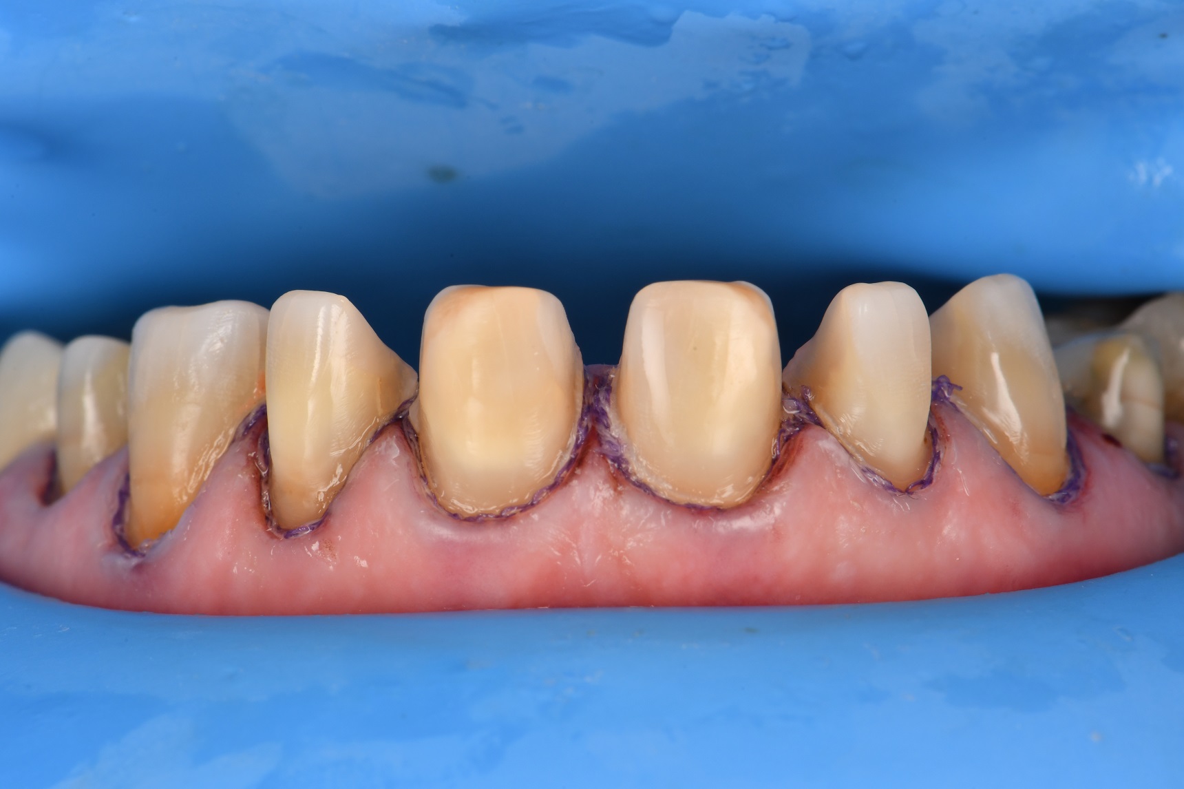 Preparations and Provisionals for an 8 unit porcelain dental makeover