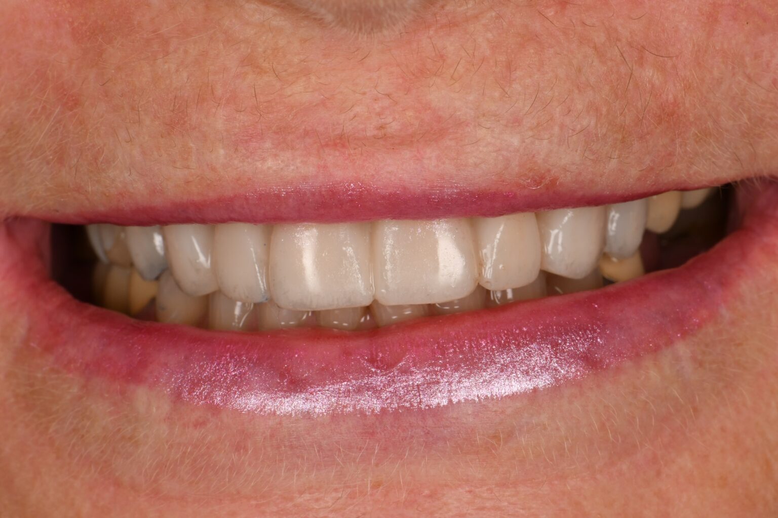 Preparations and Provisionals for an 8 unit porcelain dental makeover